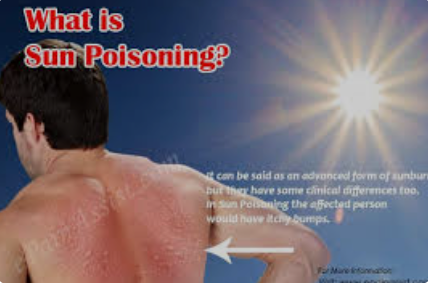 Sun Poisoning Symptoms: Recognizing the Impact of Sun Exposure
